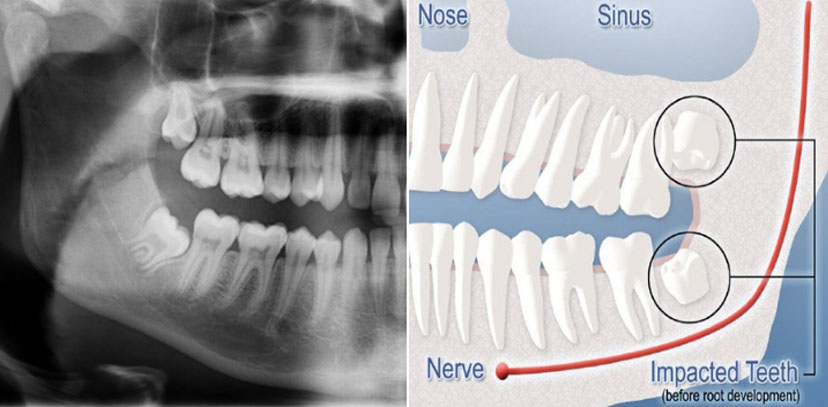 This is a black and white photograph showing an X-ray film of a human mouth with teeth, gums, and part of the jawline visible. The film is placed next to a diagram that illustrates the tooth alignment and shows arrows pointing to specific areas on the X-ray image.